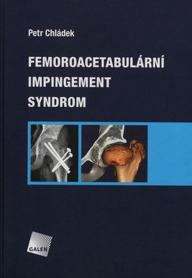 Femoroacetabulární impingement syndrom /