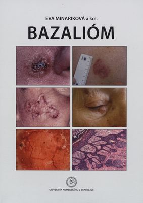 Bazalióm : sprievodca diagnostikou a liečbou bazaliómu /